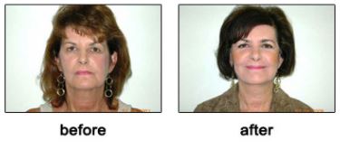Facelift Virginia Beach Va Chesapeake Facelift Before And After Pictures Virginia Beach Va