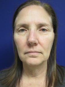 Facelift Before And After Pictures Virginia Beach Chesapeake Va Facelift Before And After Pictures Virginia Beach Va
