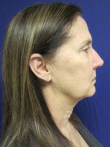 Facelift Before And After Pictures Virginia Beach Chesapeake Va Facelift Before And After Pictures Virginia Beach Va